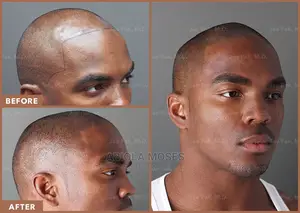 Scalp Micro Pigmentation