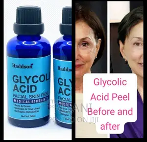 Glycolic Acid Peel