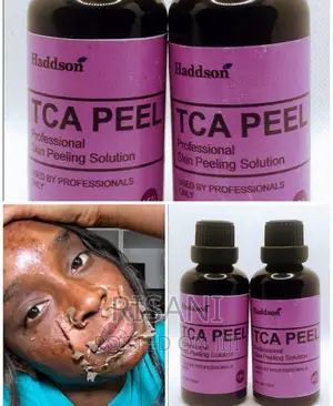 TCA Chemical Professional Peel for Acne Wrinkles,Dark Spots.