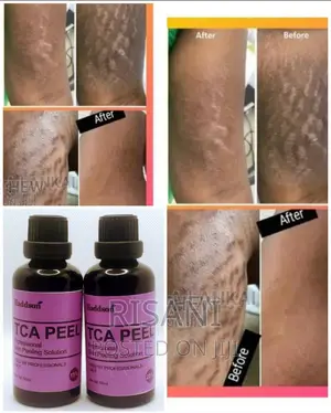 TCA Professional Chemical Peel For Stretch Marks, Acne Etc