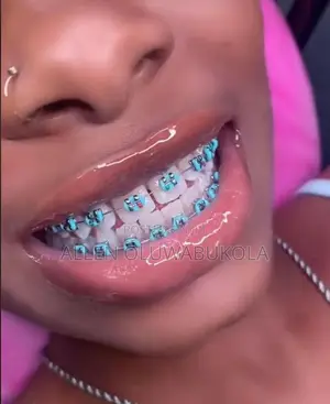 Detachable Unisex Fashion Teeth Braces