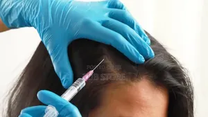 PRP Treatment for Hair Restoration