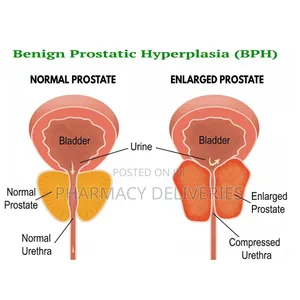 Prostate Growth Treatment With Natural Supplement Available