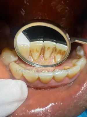 Scaling and Polishing (Professional Teeth Cleaning)