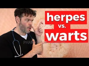 Treatment For Genital Wart HPV, Hepatitis Virus Available