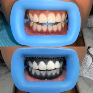 Teeth Whitening and Tooth Gems