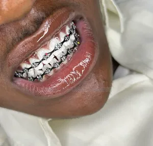 Fashion Braces Available