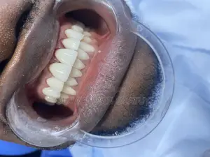 White Veneers