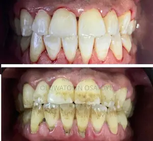 Scaling Polishing