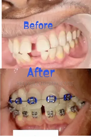Dental Braces/Treatment
