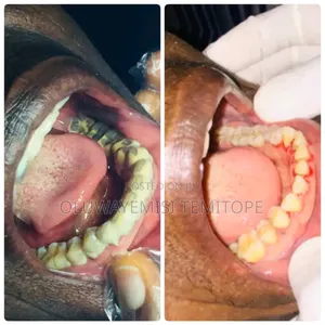Professional Teeth Cleaning