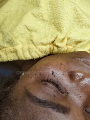 Skin Tags Removal