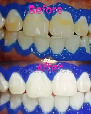 Teeth Whitening