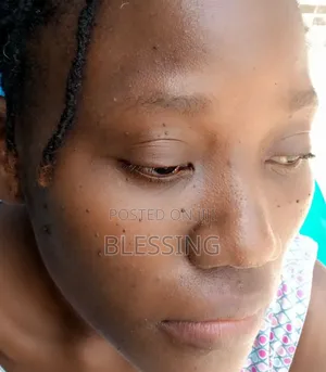 Skin Tags Removal
