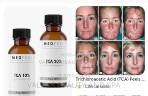 Tca Chemical Peel, for Stretch Mark, Stubborn Dark Spot