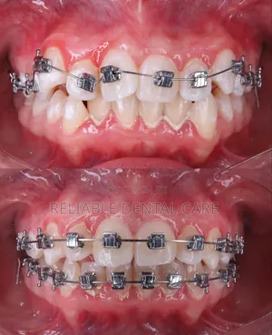 Dental Braces Treatment