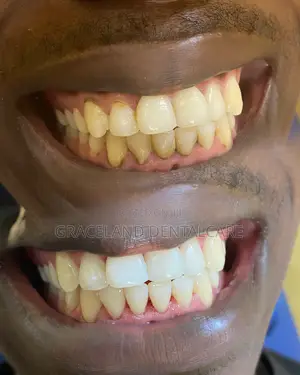 Teeth Whitening in Alimosho/Alagbado/Iyana-Ipaja/Kola/Ayobo/Agege