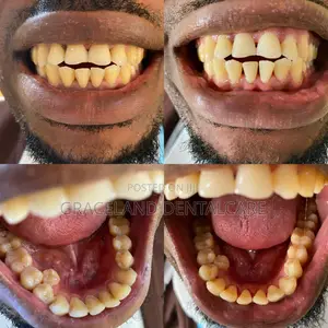 Teeth Cleaning and Whitening in Lagos Mainland