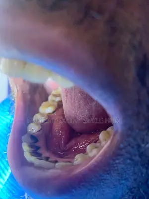 Dental Cleaning/ Teeth Cleaning
