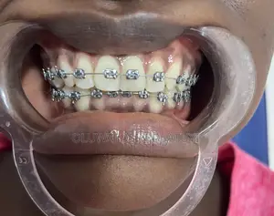 Braces for Correction of Teeth