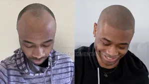 Scalp Micropigmentation Smp - Hair Loss, Baldness And Alopecia