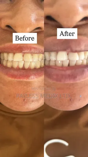 Teeth Whitening Services