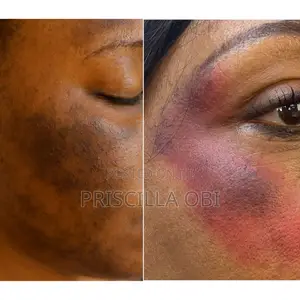 Professional Sunburn Treatment in Benin City