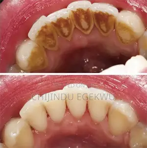 Dental Scaling and Polishing