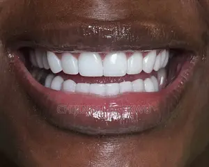Dental Cosmetic Veneers