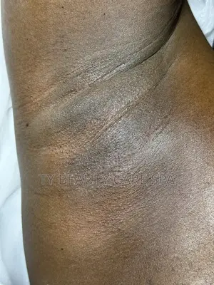 Waxing (Hair Removal)
