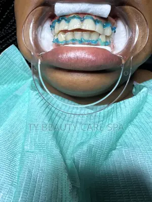 Teeth Whitening Session