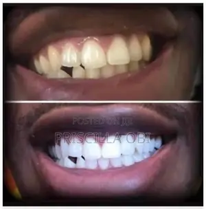 Professional Teeth Whitening Service