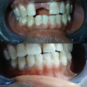 Special Discount for Teeth Cleaning/Washing