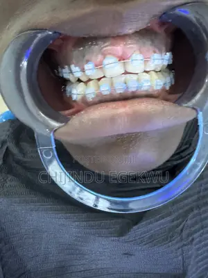 Orthodontic Treatment (Braces)