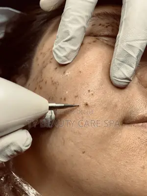 Skin Tags Removal