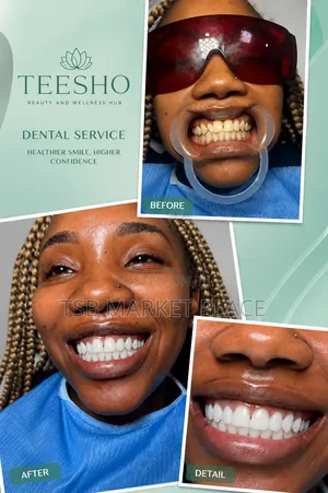 Laser Teeth Whitening and Scaling and Polishing