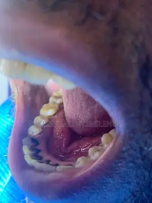 Professional Teeth Cleaning
