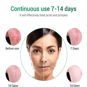 Breylee Acne Treatment Serum