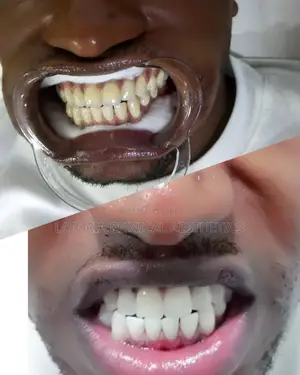 Advanced Laser Teeth Whitening